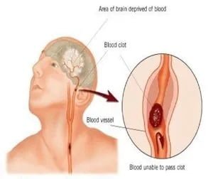 stroke recovery, natural healing clinic